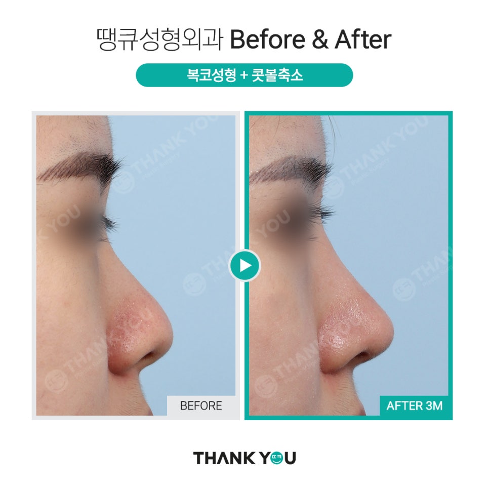 코 재수술시 기존 실리콘은 꼭 제거해야 되나요? 관련 이미지 12