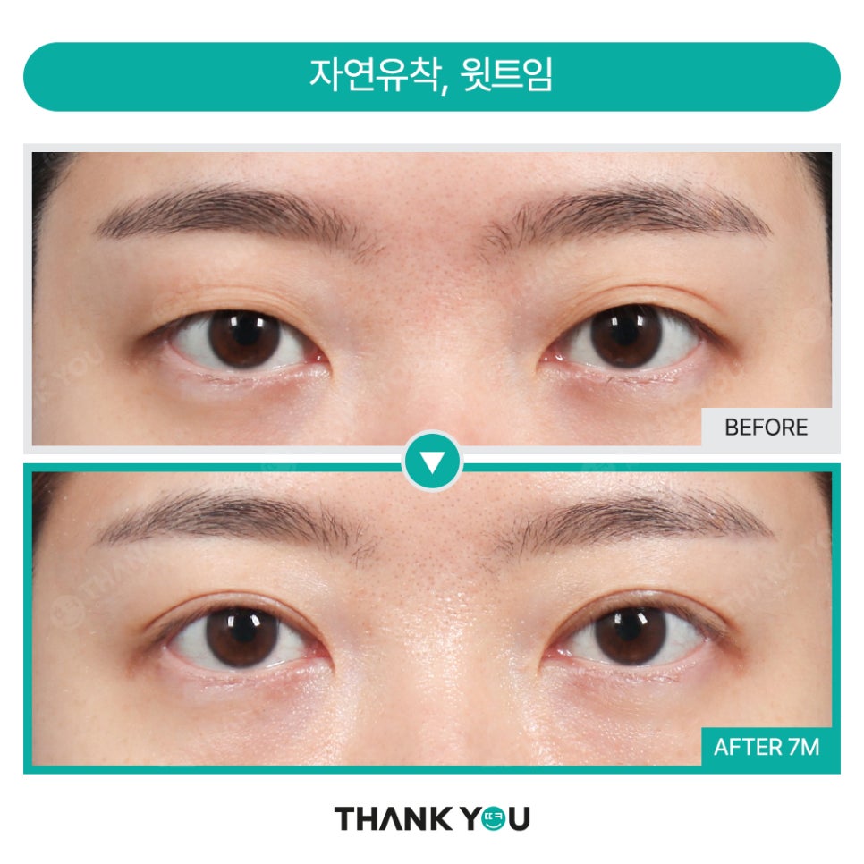 [비절개눈매교정+앞윗트임+눈밑지] 자고 일어났을 뿐인데 제니가?! 관련 이미지 16