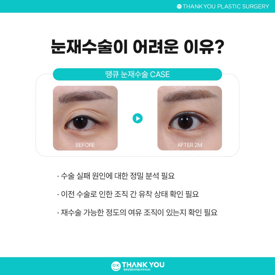 눈재수술병원 잘 고르려면?! 맞춤 수술 여부가 핵심👍 관련 이미지 4