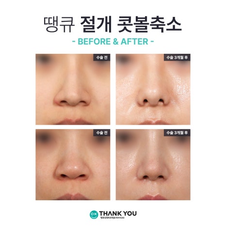 콧볼성형 찾는다면 여기! 땡큐 콧볼축소로 세련된 이미지 완성하기! 관련 이미지 12