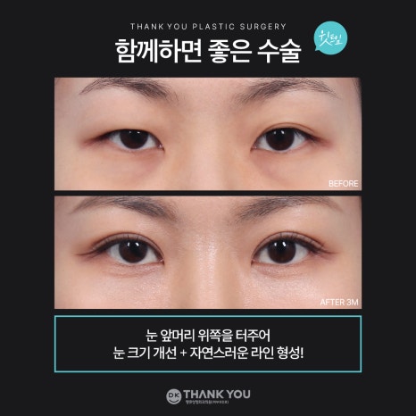 눈매교정잘하는곳 땡큐에서 더 또렷하게, 더 자연스럽게! 관련 이미지 7