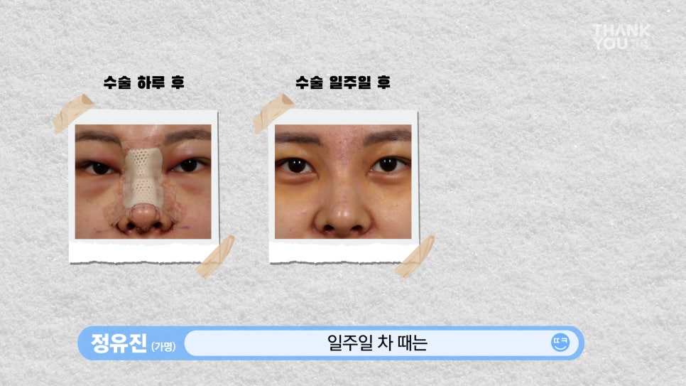 뚱뚱한 코 탈출! 실리콘 코성형👃(직원 코성형 브이로그2탄) 관련 이미지 12