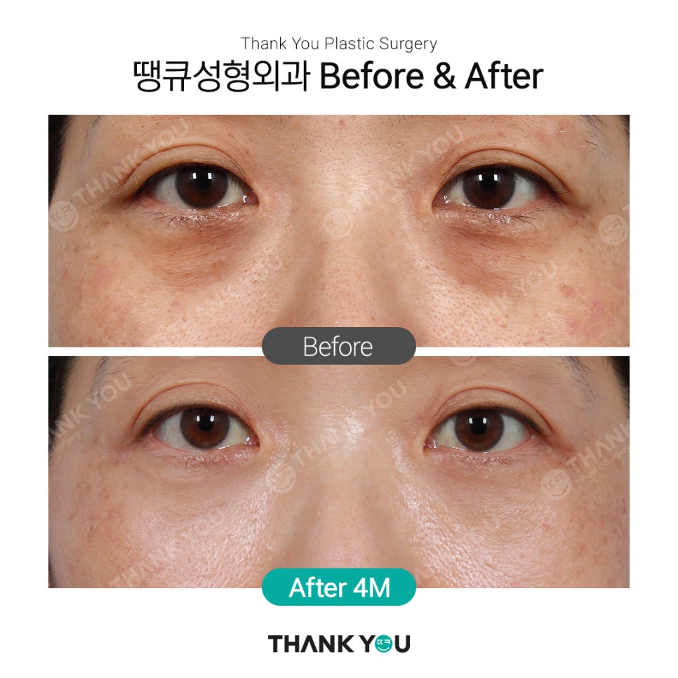 땡큐에서 알려드리는 눈밑지방재배치 Check point ❗ 관련 이미지 6