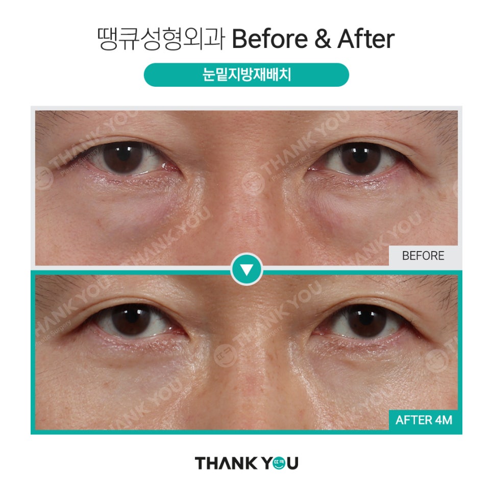 붐 눈밑지방재배치? 남자 눈밑지 전후 (붐, 남창희, 김동현) 관련 이미지 4