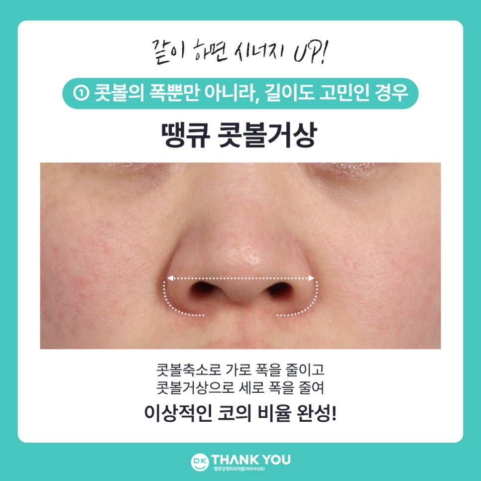 콧볼성형 찾는다면 여기! 땡큐 콧볼축소로 세련된 이미지 완성하기! 관련 이미지 7