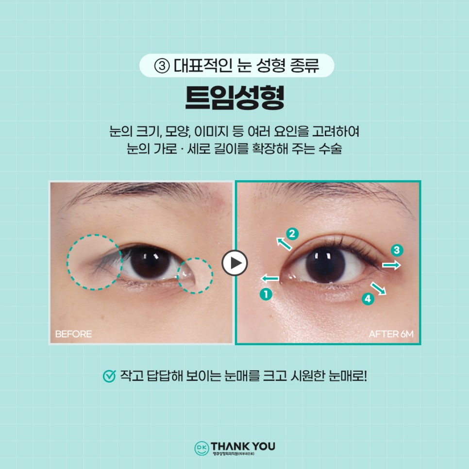 첫눈성형, 자연스럽고 조화로운 결과를 위해서는?! 관련 이미지 4