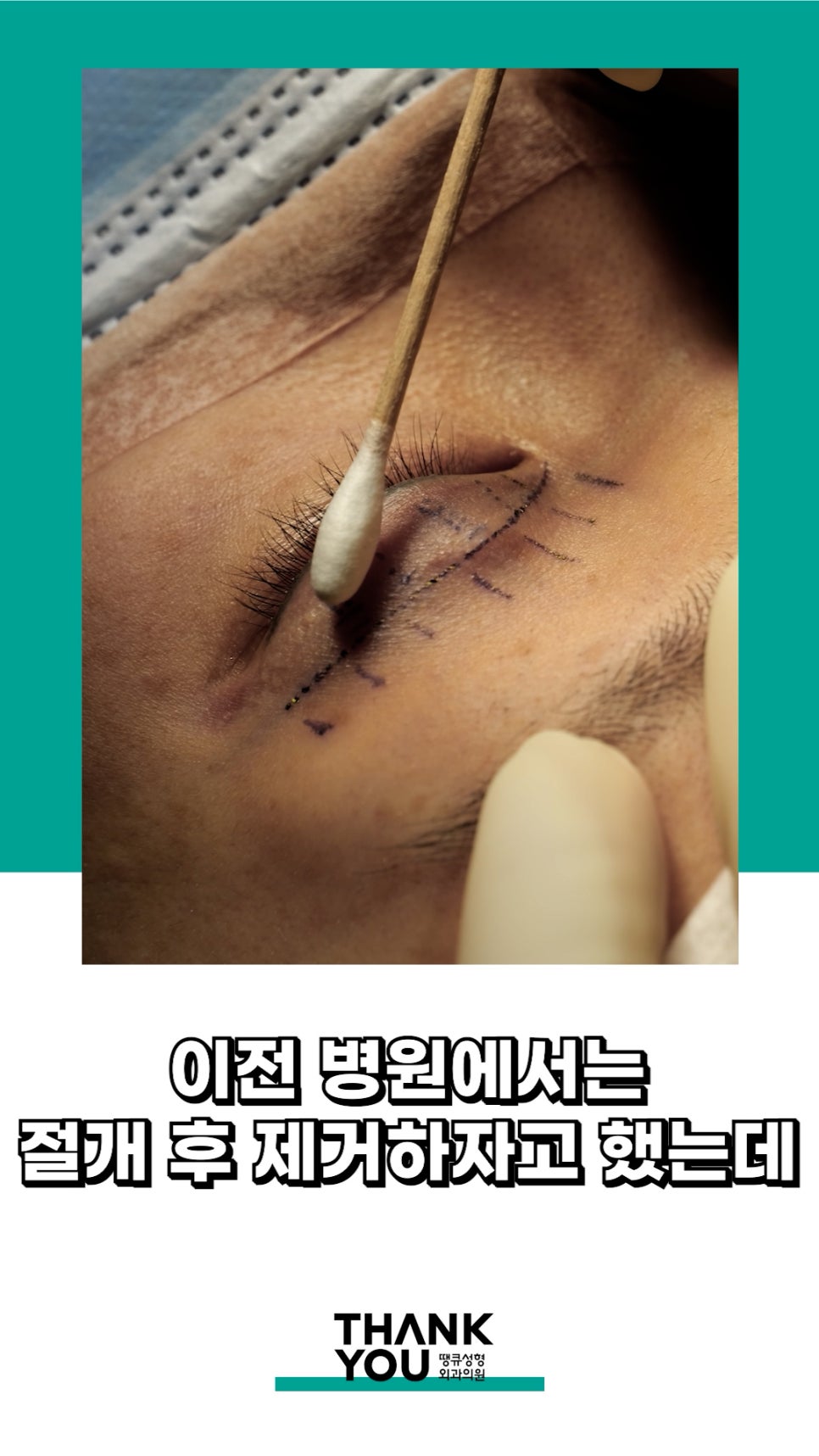 3번 눈재수술? 근데 실제거를 안했다고? 땡큐에서 전부 실제거! 관련 이미지 12