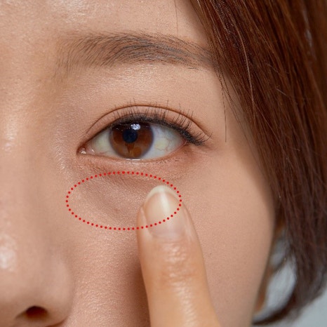 눈밑수술, 눈밑지방이식도 가능한가요? 관련 이미지 3