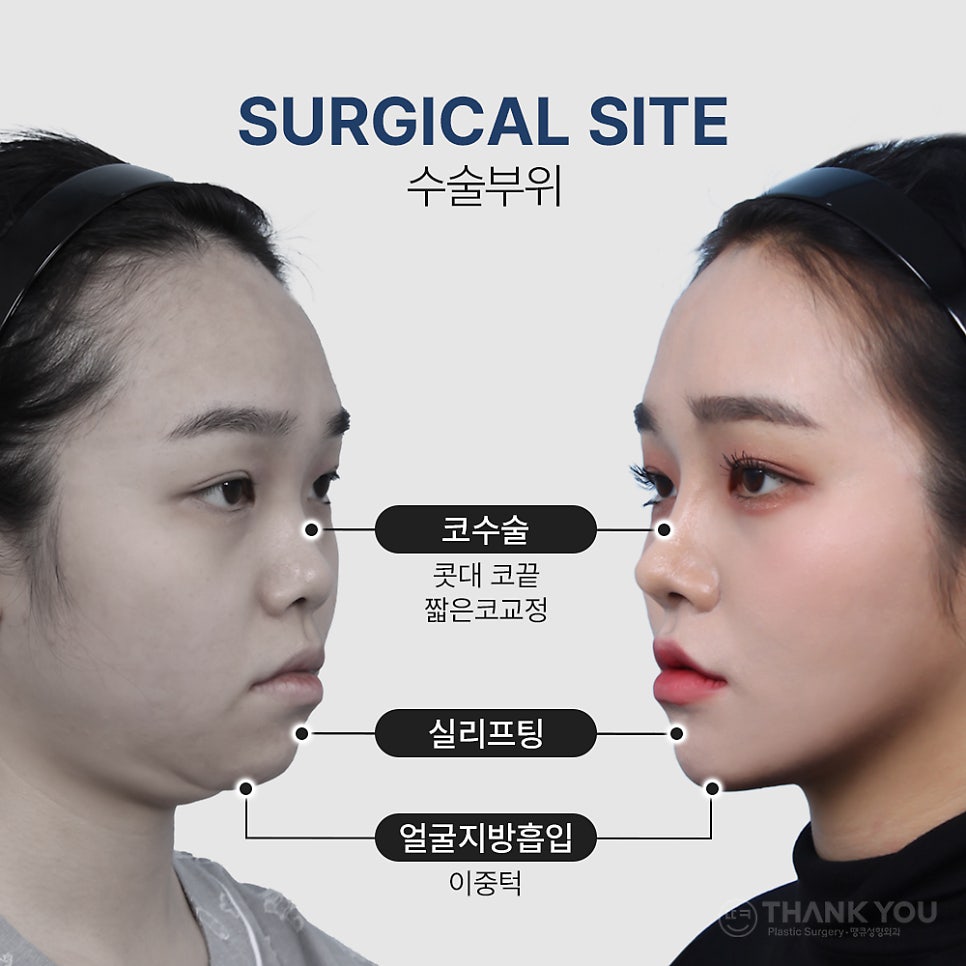 낮은코성형&얼굴지방흡입 후기 (땡큐성형외과 Real Story) 관련 이미지 2