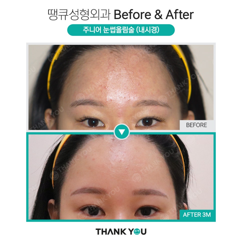 나이가 어린데도 이마거상을 꼭 해야 할까요? 관련 이미지 12