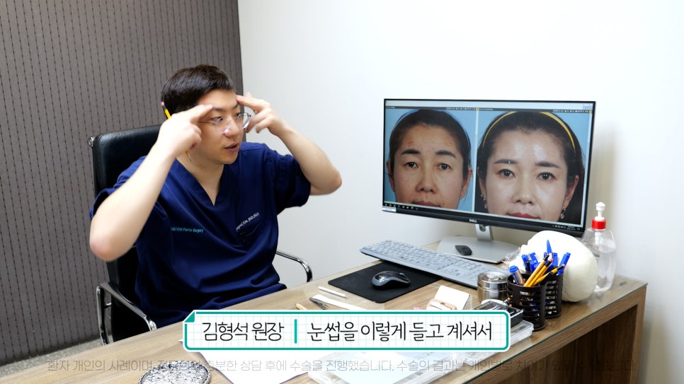 중년눈성형 전후& 이마거상+눈썹하거상+쌍수로 젊어지기 관련 이미지 15