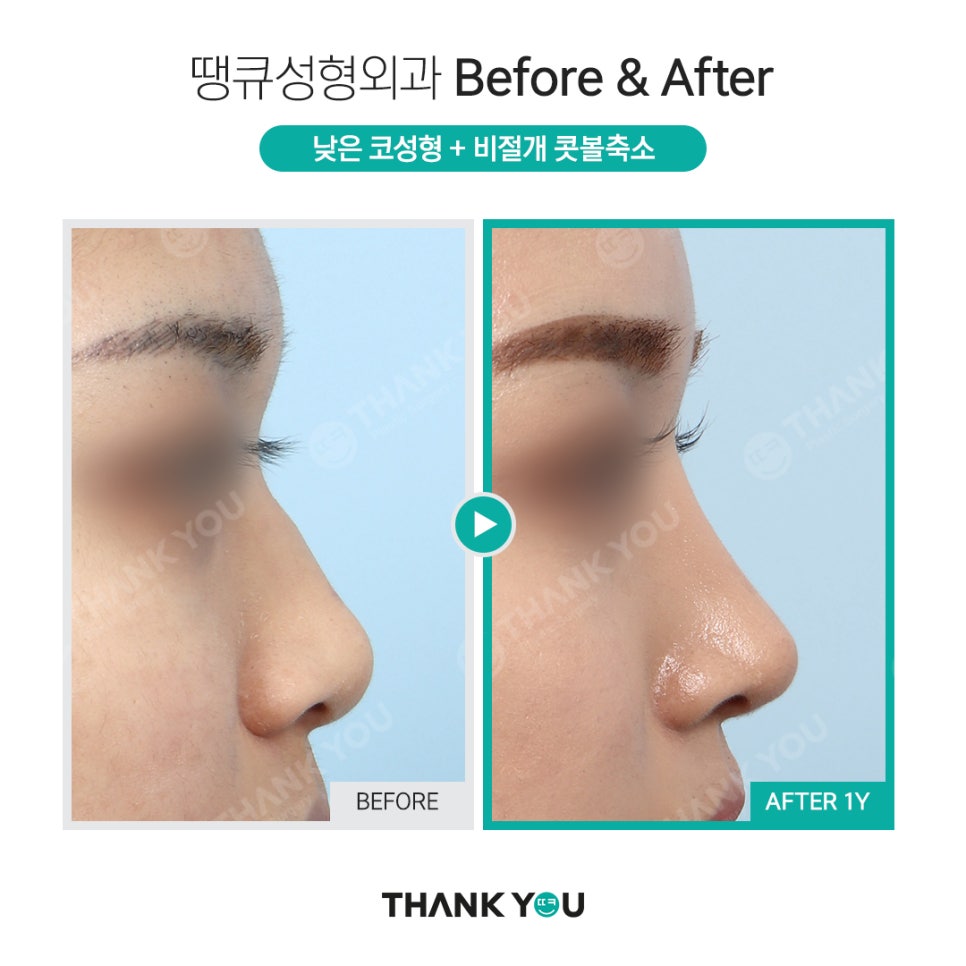 짧은코 교정의 역발상, 짧은코 성형 전후 관련 이미지 12