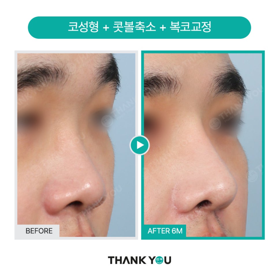 신논현역 성형외과, 남자 휜코성형, 매부리코 성공 포인트는? 관련 이미지 5