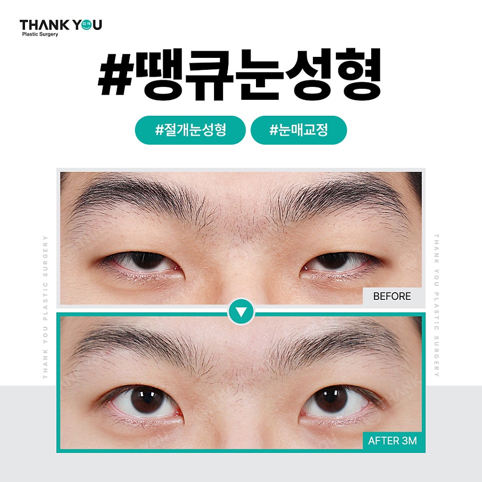쌍꺼풀 라인 종류, 내게 맞는 쌍수랑 트임은?(인라인) 관련 이미지 4