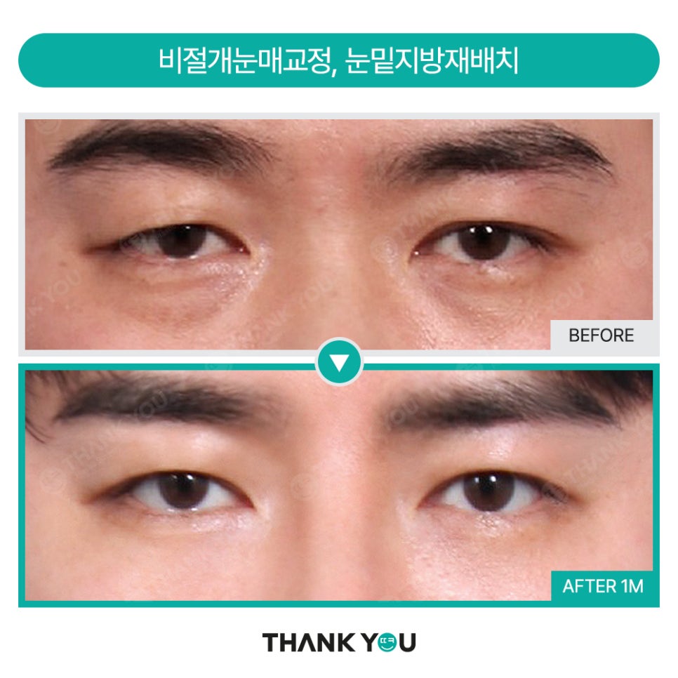 MAKE미남(맥미남) 오덕차장님의 노안 개선&남자 비염코성형 전후 관련 이미지 11