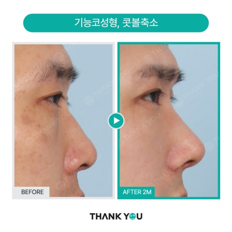 [맥미남 병원] 남자 휜코 성형, 막힌코수술, 코막힘 등 전후 까지 관련 이미지 7