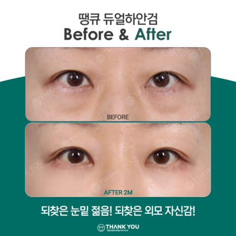 If You Want a Satisfying Difference Before and After Lower Blepharoplasty?! Thank You Dual Lower Blepharoplasty image 8