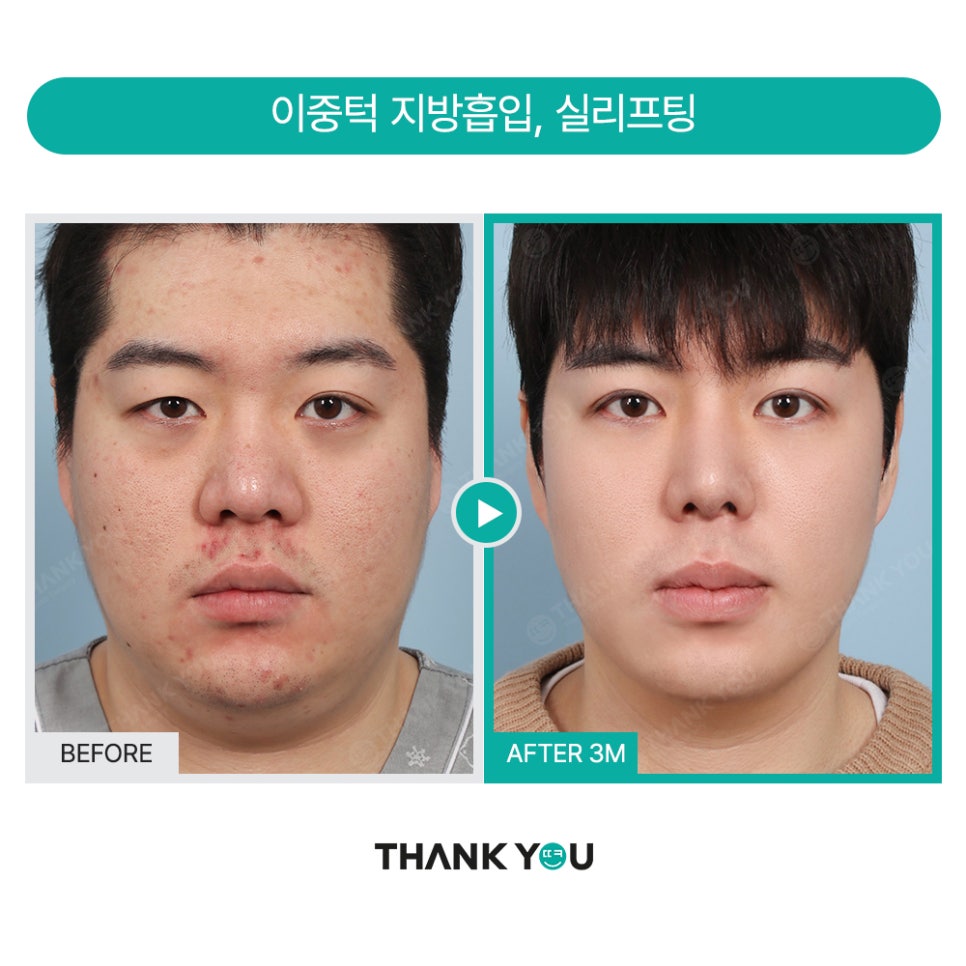 땡큐 맥미남, 뮤지컬배우 남자 복부지방흡입 전후 Check 관련 이미지 14
