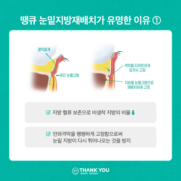 눈밑꺼짐수술? 눈밑지병원에서 내게 딱 맞게! 관련 이미지 7