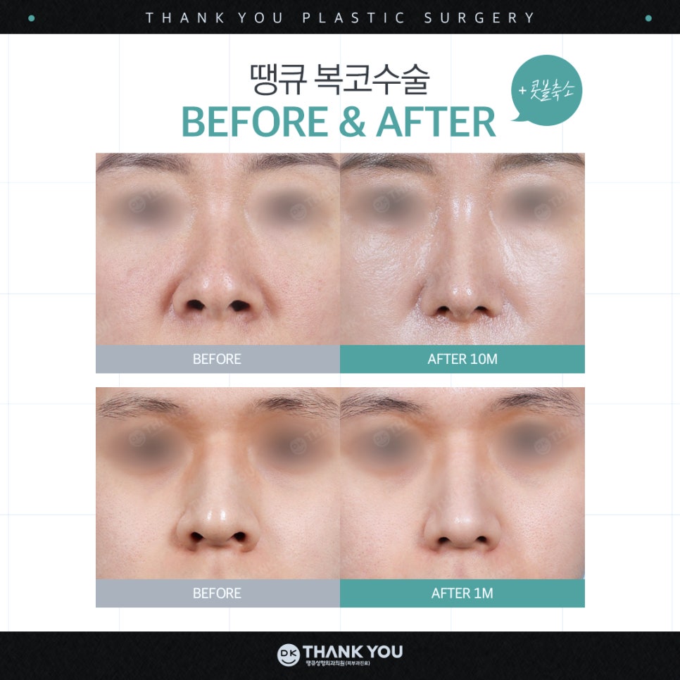 A Great Bulbous Nose Surgery Review: Making a Slim Nose at Thank You! image 10