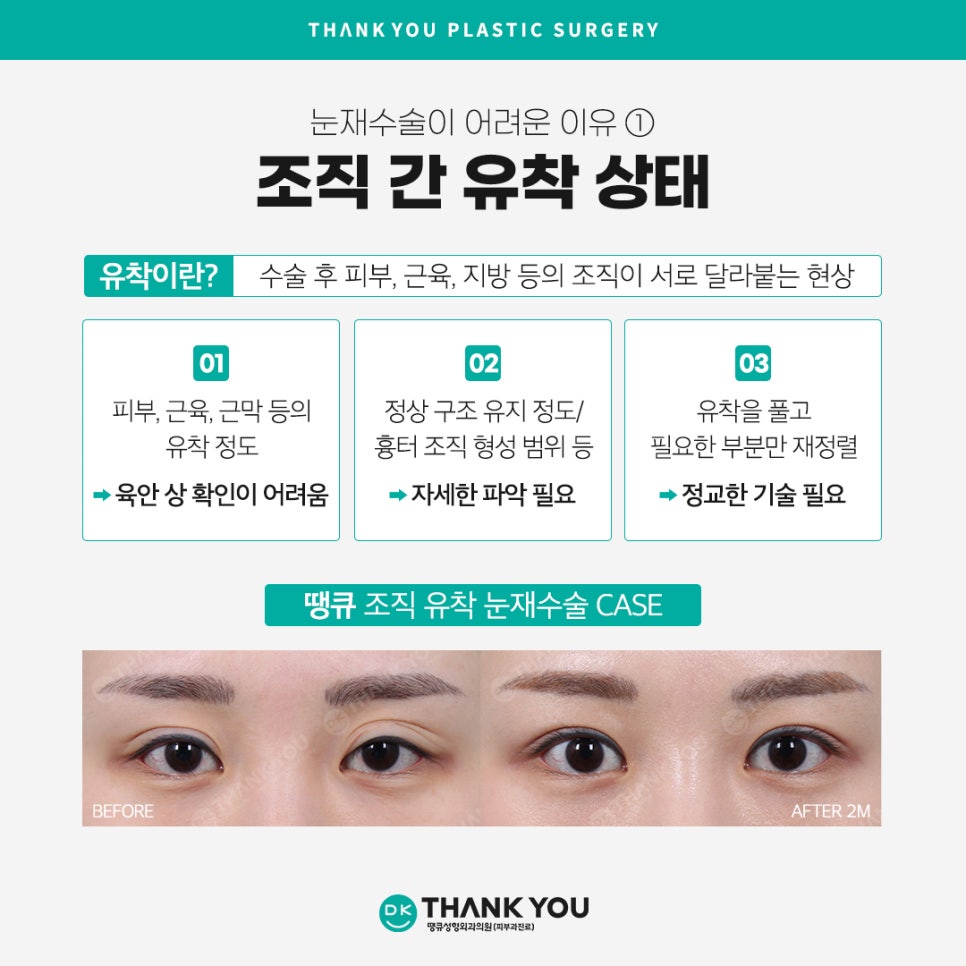 눈재수술병원 선택 시 신중해야 하는 이유는?! 관련 이미지 4