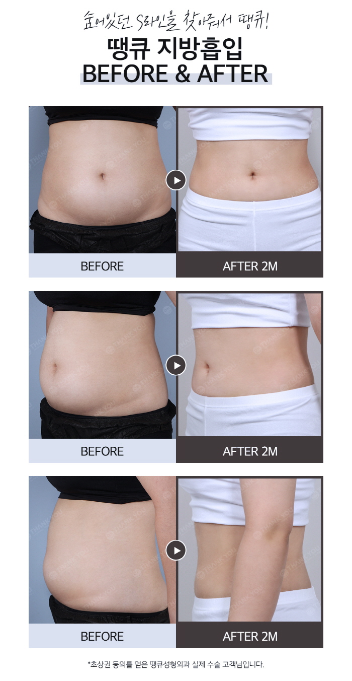 Difference Before and After Liposuction? See the Results with Thank You 1-Point Liposuction! image 6