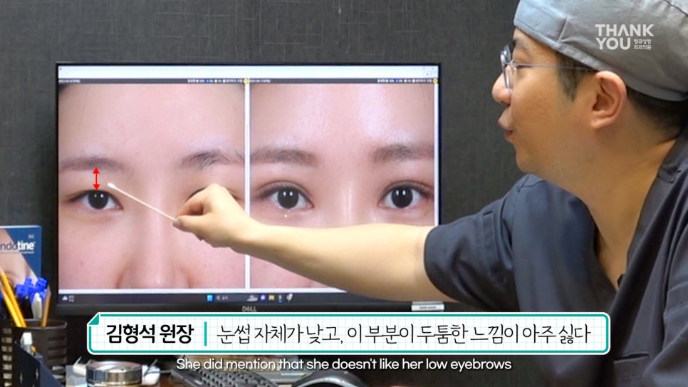 쌍수에 눈썹올림술을 추천하는 이유?! 관련 이미지 8