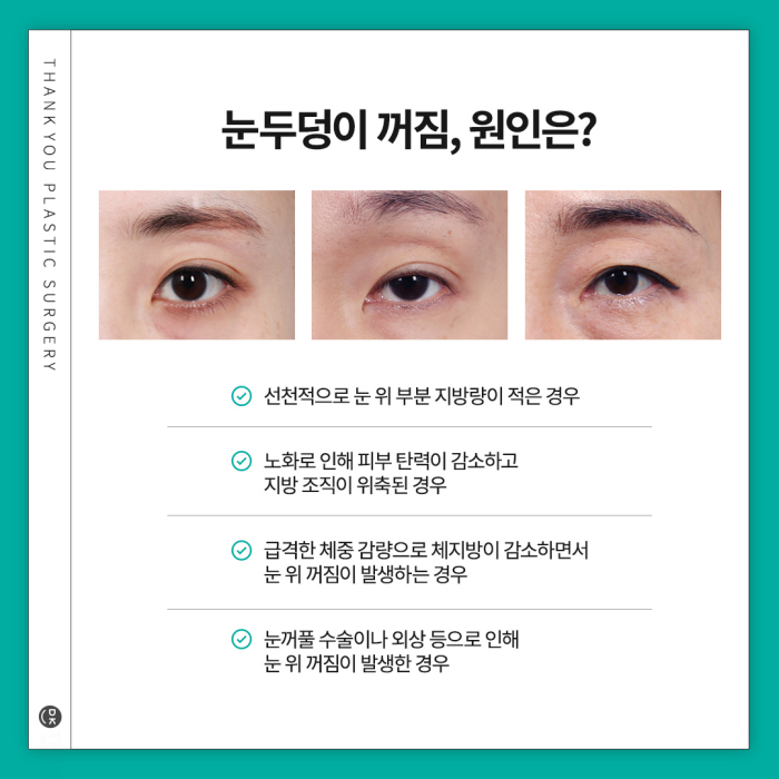 눈두덩이지방이식으로 피곤한 이미지 탈출! 생기있는 눈매 완성! 관련 이미지 2