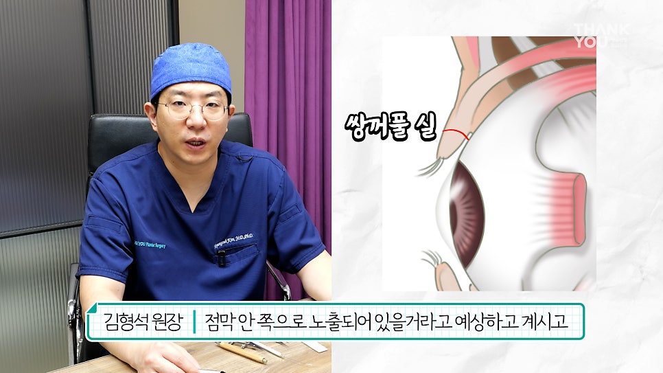 '쌍꺼풀 실 눈찌름'으로 안과? 쌍수실 제거+자연유착 라인 살리는 법 관련 이미지 7