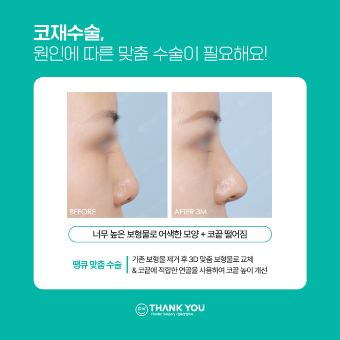 코재수술병원에서 알려주는 재수술하게 되는 이유! 관련 이미지 6