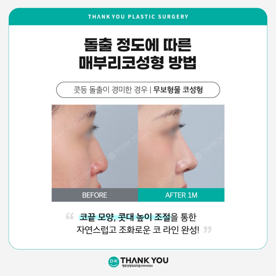 매부리코개선, 돌출 정도에 따른 맞춤 수술이 중요! 관련 이미지 5