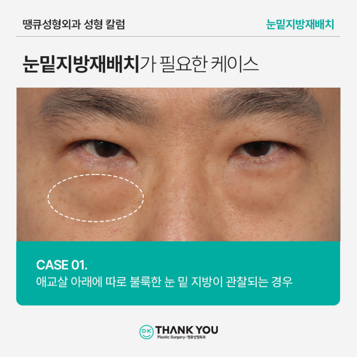 눈밑지방재배치병원에서 알려주는 수술이 필요한 케이스 관련 이미지 4