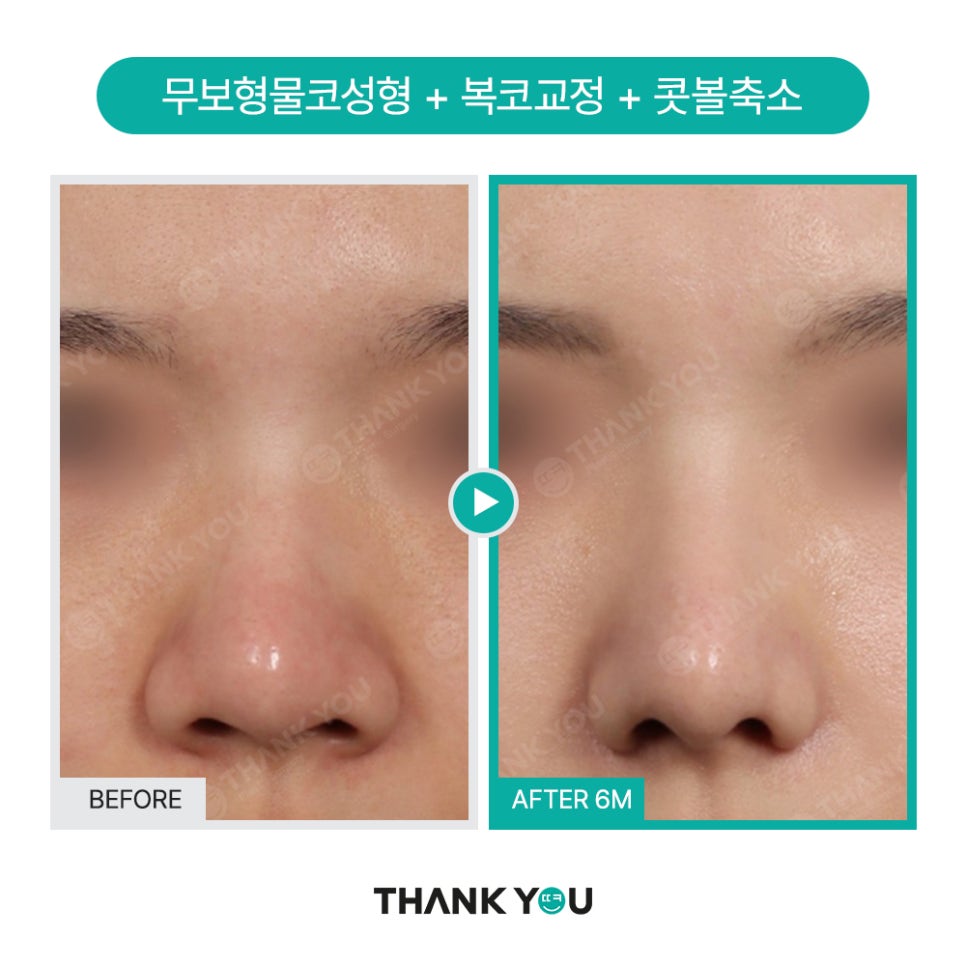 이런 코는 무조건 성공?! 코성형 성공 유형 관련 이미지 5