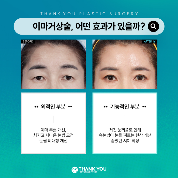 What Are the Effects of a Forehead Lift?[Column by Director Kim Gyu-beom] image 4