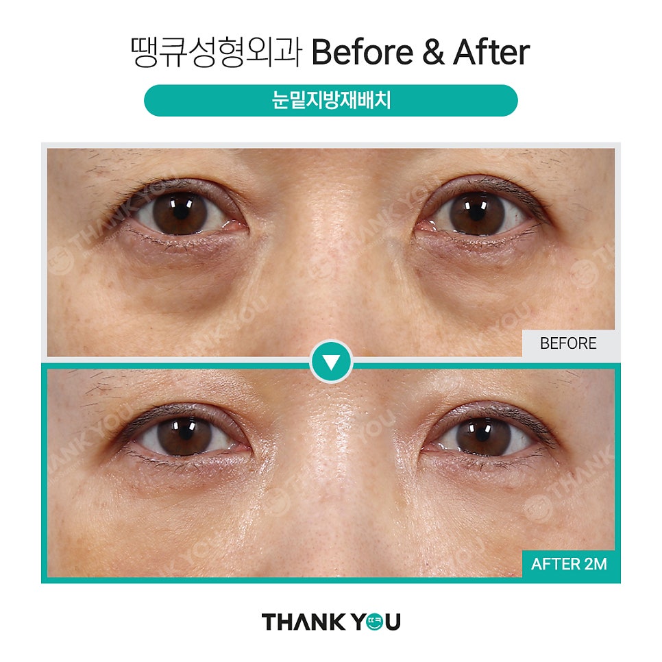 눈밑지 지방이식? 앞광대지방이식 필요한 이유? 관련 이미지 8