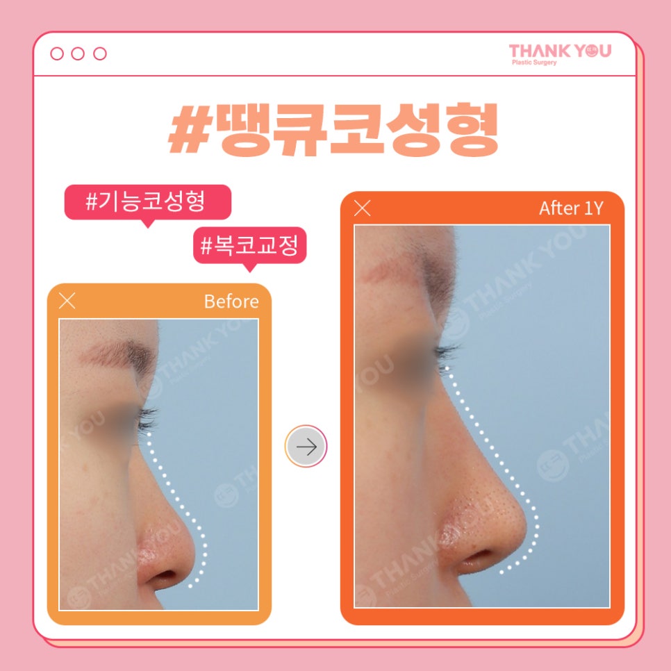 코성형 전후, 코모양 신논현역 성형외과에서 체크 관련 이미지 5