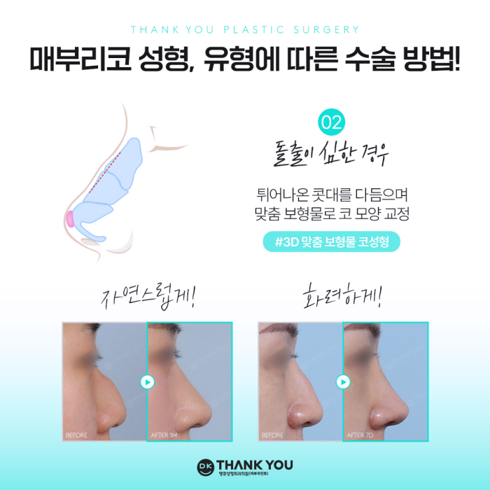 Hump Nose Improvement: Personalized Surgery Is Important! image 5
