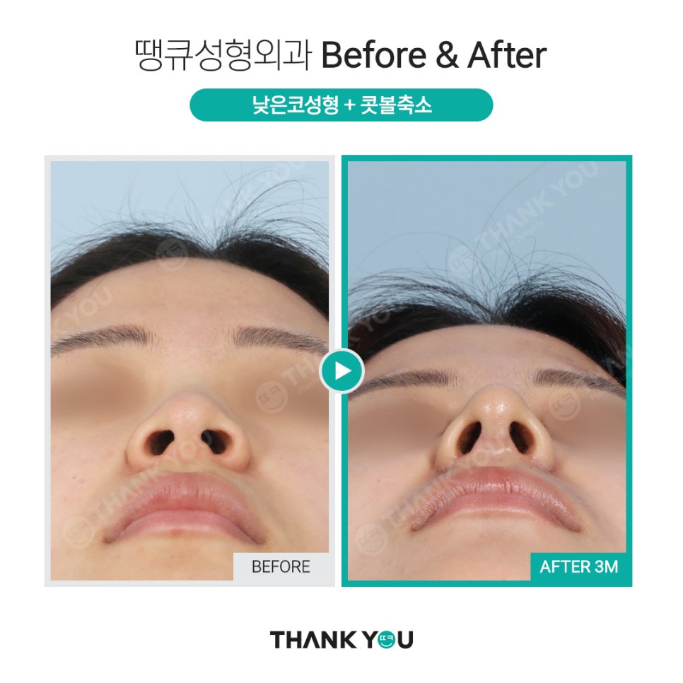 코 성형전, 코필러 꼭 제거해야 하나요? [코 수술전 필독!] 관련 이미지 8