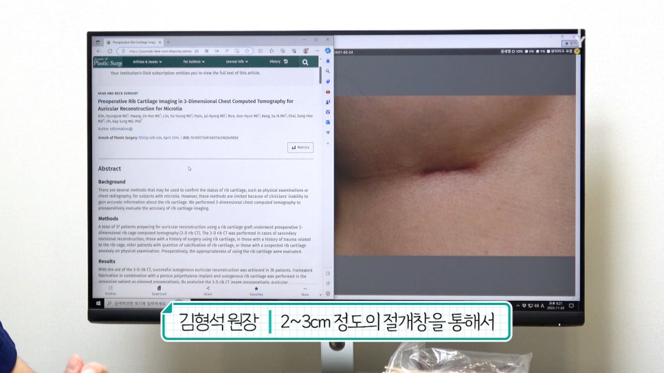 자가늑연골 코수술 장단점, 실리콘없이 무보형물 전후Check 관련 이미지 5