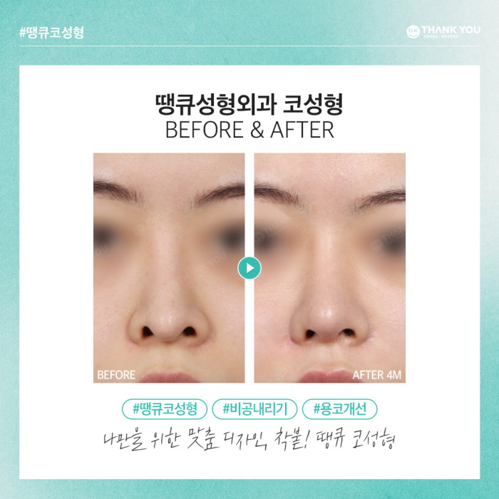 비공내리기로 용코교정하고 조화로운 코 만들기🍀 관련 이미지 6