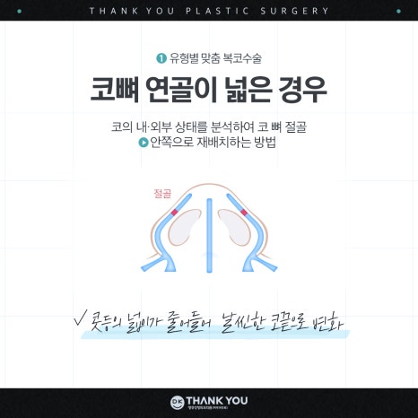 A Great Bulbous Nose Surgery Review: Making a Slim Nose at Thank You! image 4