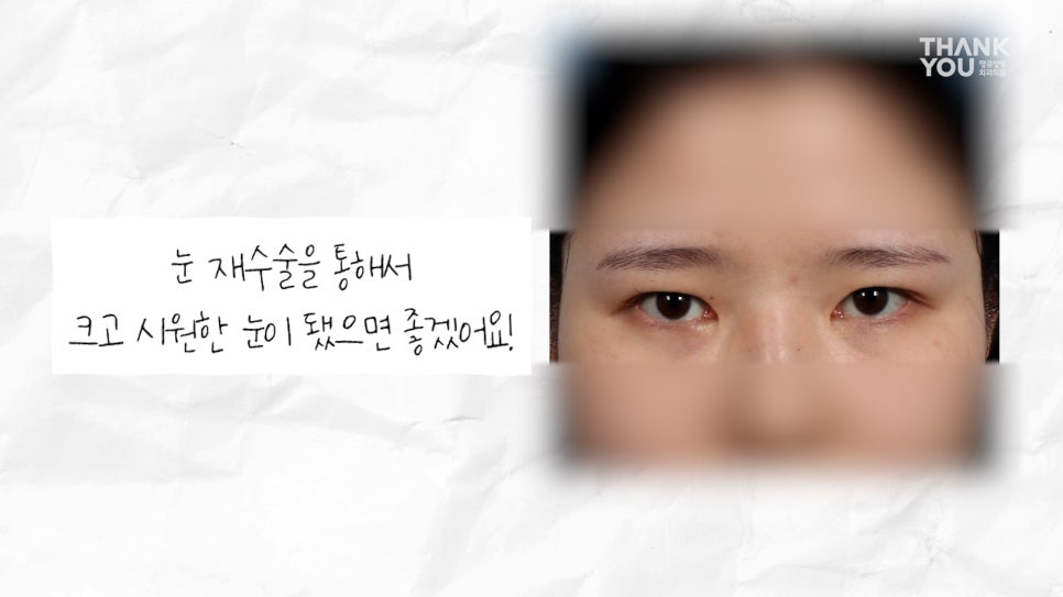 눈재수술 할 때 이마거상 추천하는 이유는? (눈썹올림술 전후) 관련 이미지 10