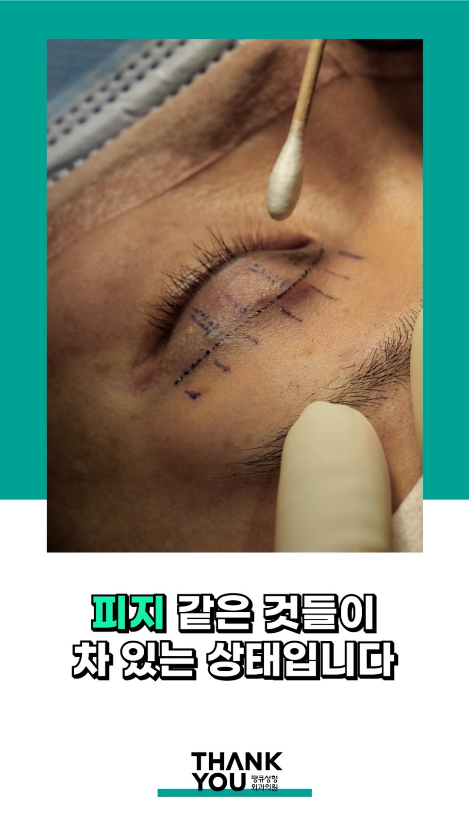 3번 눈재수술? 근데 실제거를 안했다고? 땡큐에서 전부 실제거! 관련 이미지 9