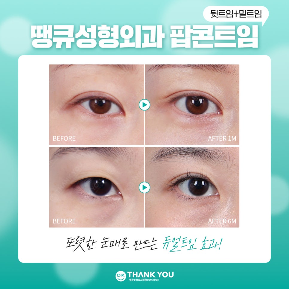 눈트임수술 [땡큐 팝콘트임]으로 듀얼트임 효과내기✨ 관련 이미지 7