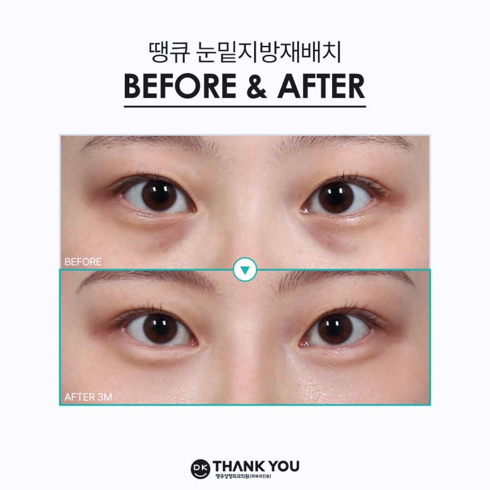 눈밑지방재배치 사시 부작용 궁금증 해소해 드립니다! 관련 이미지 11
