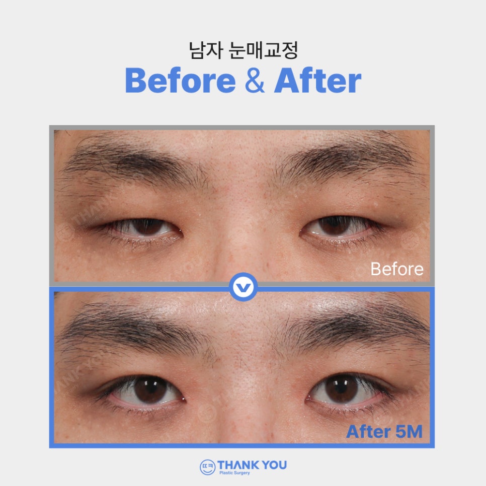 안검하수에 필요한 눈매교정 (ft.전후사진 체크) 관련 이미지 5