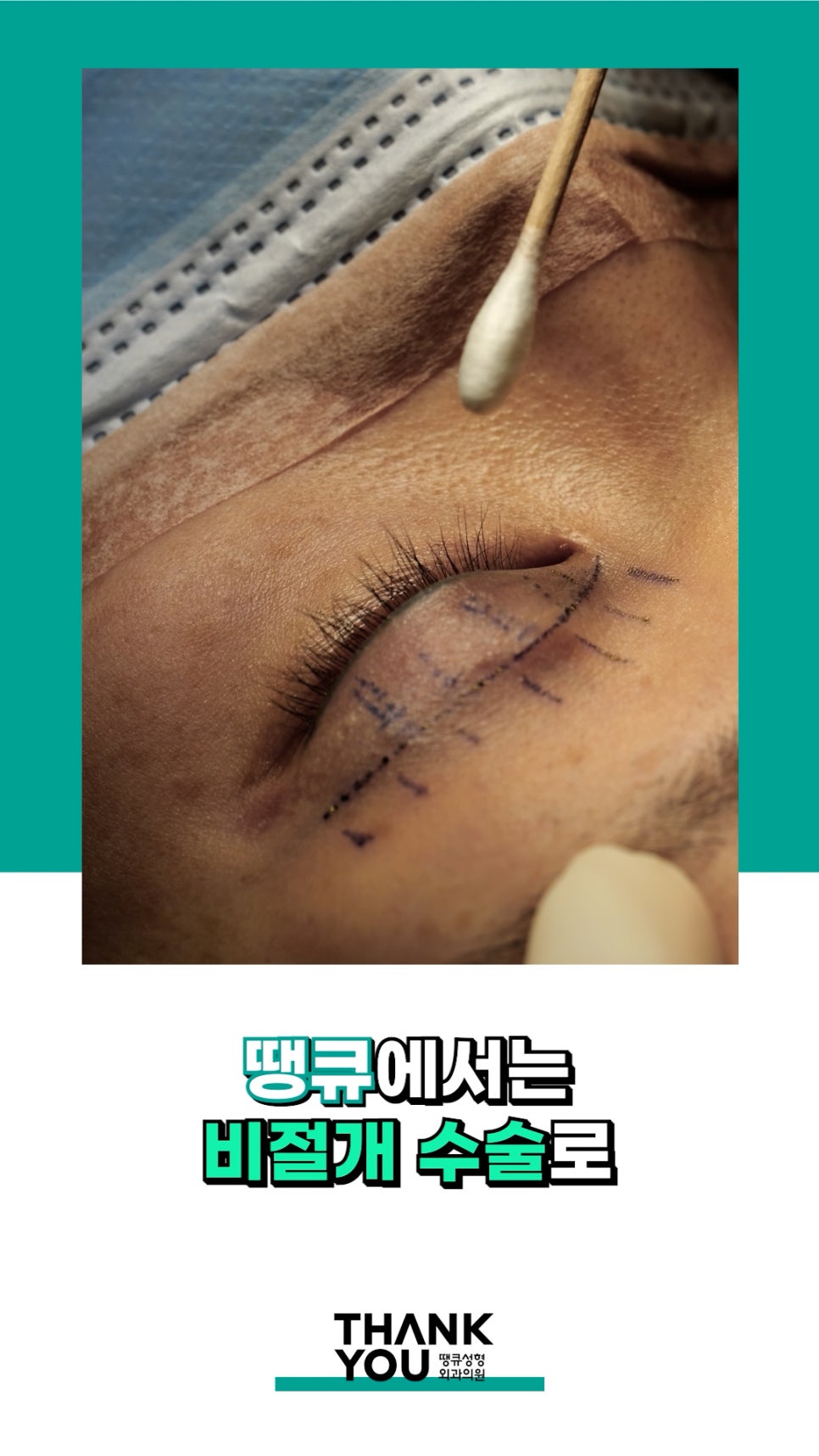 3번 눈재수술? 근데 실제거를 안했다고? 땡큐에서 전부 실제거! 관련 이미지 13