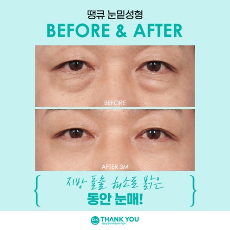 눈밑성형수술 만족도를 높이는 방법은? 관련 이미지 7