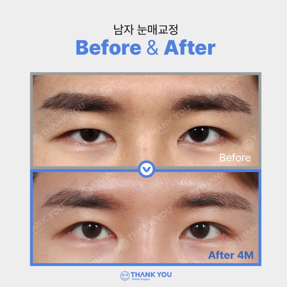 안검하수에 필요한 눈매교정 (ft.전후사진 체크) 관련 이미지 6