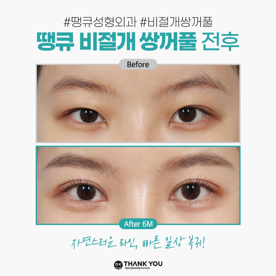 쌍꺼풀잘하는병원 땡큐에서 알려주는 절개vs비절개 수술법의 특징! 관련 이미지 3